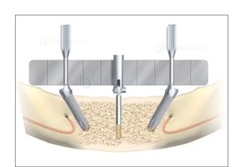 Gu&iacute;a angular flexible para posicionamiento de implantes dentales